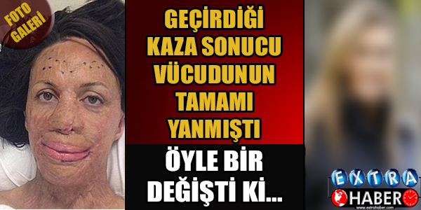 GEÇİRDİĞİ KAZA SONUCU VÜCUDUNUN TAMAMI YANMIŞTI ÖYLE BİR DEĞİŞTİ Kİ...