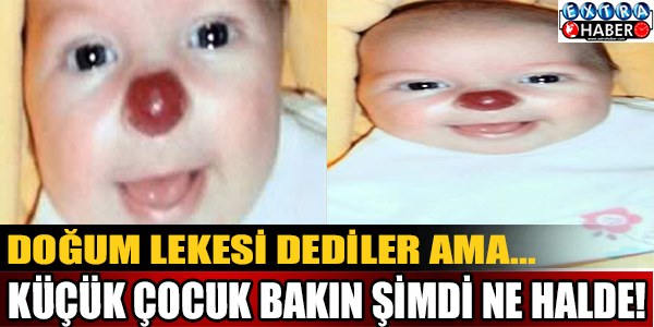 Doğum lekesi dediler ama... Küçük çocuk bakın ne halde!